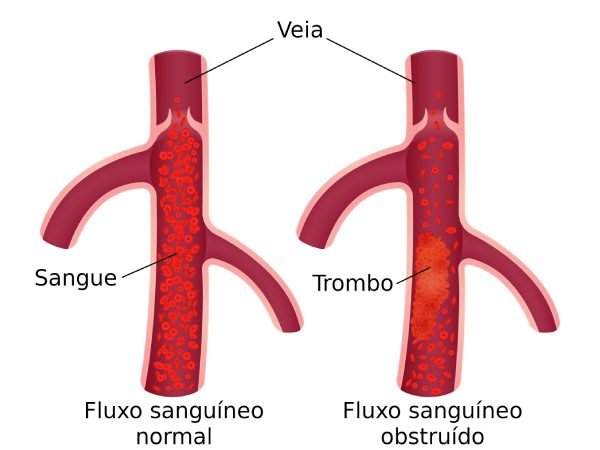 Trombose nas veias