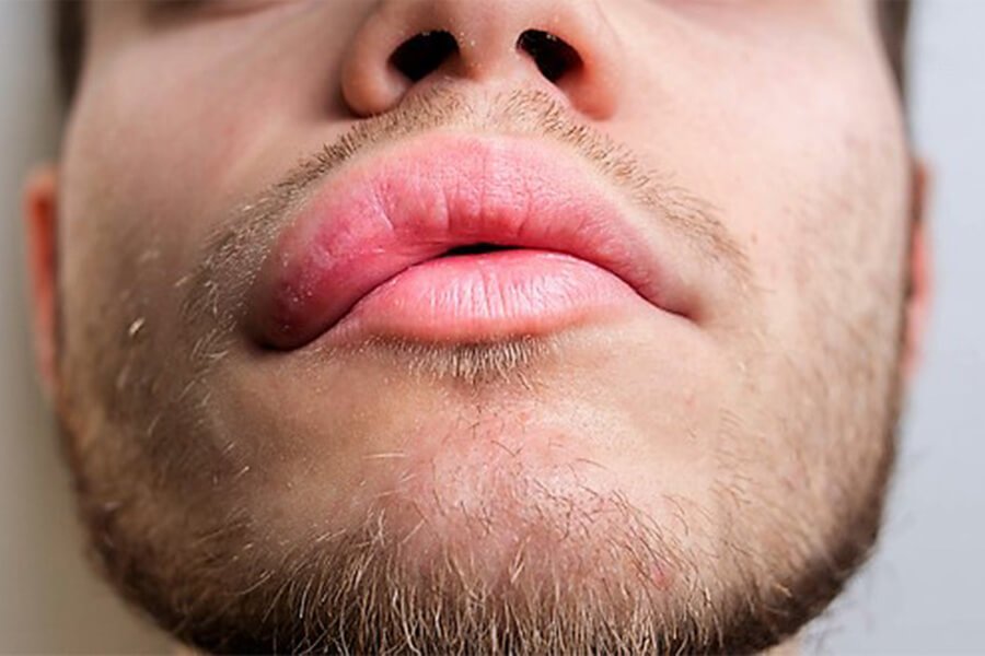 Angioedema