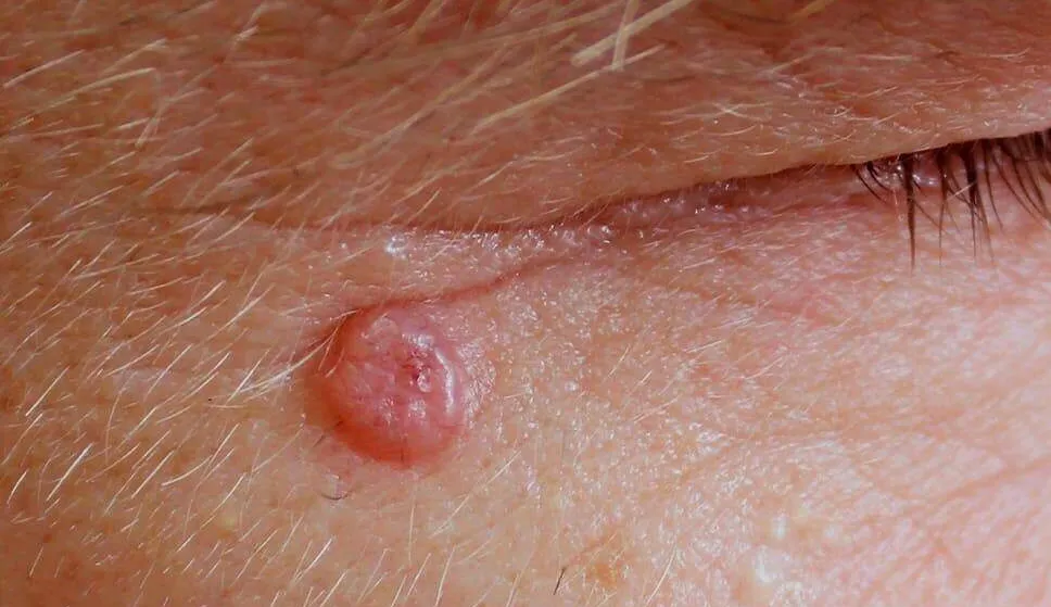 Carcinoma Espinocelular